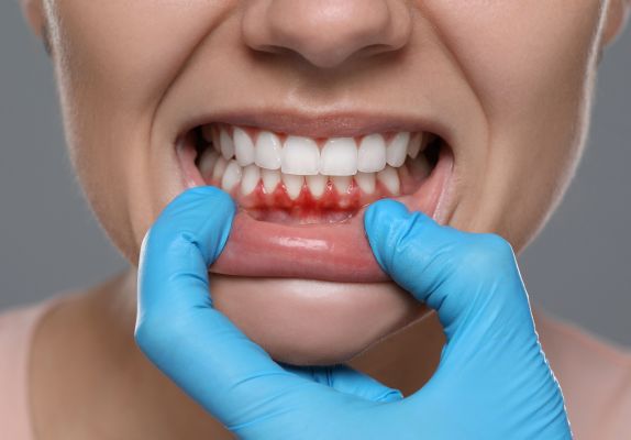 gum treatment in gurgaon