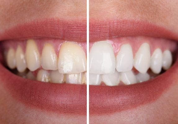 teeth cleaning in gurgaon